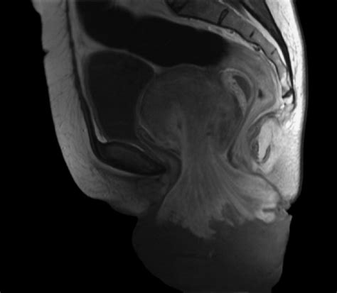 Spontaneous Prolapse Of Pedunculated Uterine Submucosal Leiomyoma