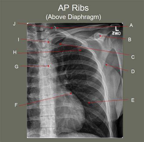 Ribs Xray Oblique At James Vann Blog