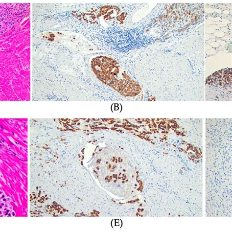 MUC1 Expression And Pathological Features Of Gastric Cancer A