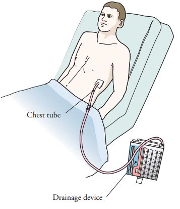 После торакальной хирургии | Memorial Sloan Kettering Cancer Center