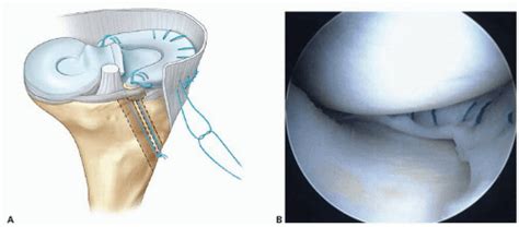 Meniscus Transplantation Musculoskeletal Key