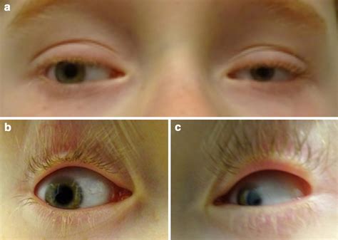 Coloboma Of The Eye