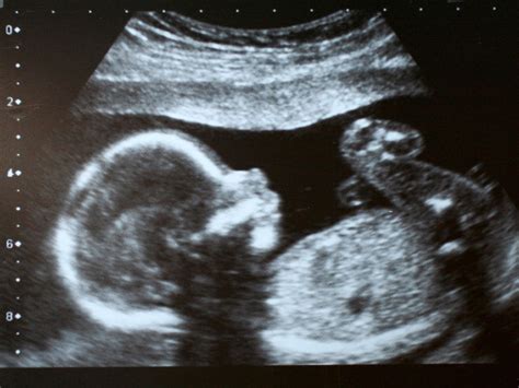 Nub Theory Will A Dating Scan Show The Sex Of My Baby Babycentre Uk