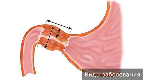 Пилороспазм. Как лечить пилороспазм. - YouTube