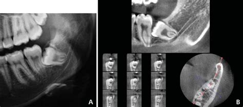 A Cropped Panoramic Radiograph Shows The Interruption Of The Superior