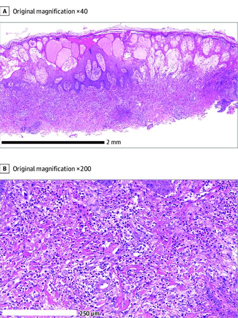 Hematoxylin Eosin Stained Sections A Irregular Hyperplasia And