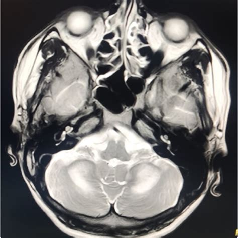 Mri Scan Of Cerebellum Showing Hyper Intensity Along The Medial Aspect Download Scientific