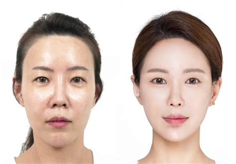 Korean Plastic Surgery Before And After