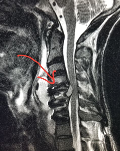 #Neck #MRI: #infection (#discitits) w/ #abscess into the #spinal canal