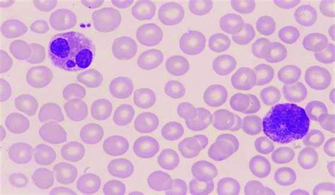 Basophil With Large And Dark Colored Granules In The Cytoplasm Of
