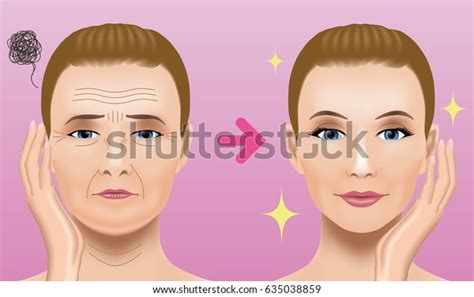 얼굴 주름성형수술여성 얼굴 치료 개념 스톡 벡터로열티 프리 635038859 Shutterstock