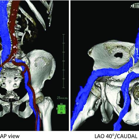 Anatomy Of The Bilateral Femoral Veins As Depicted By 3 Dimensional