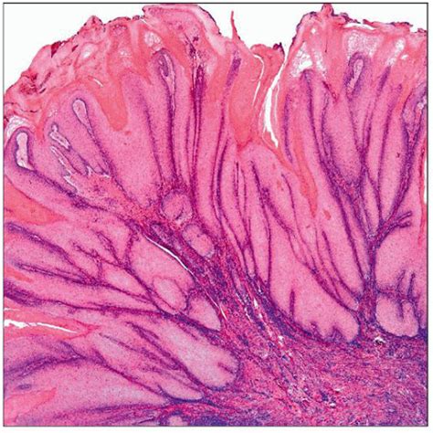 Verrucous Carcinoma (and Variants) | Basicmedical Key