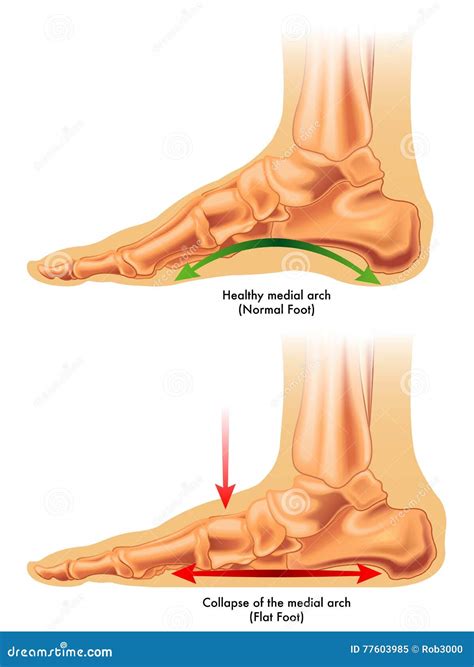 Foot Stress Fractures As Bone Cracking Trauma Or Injury Outline Diagram