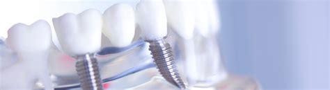 Colocação de implantes dentários Clínica Dal Pizzol