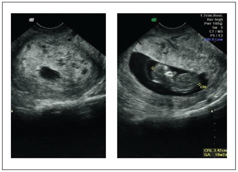 Scielo Brasil Neoplasia Trofobl Stica Gestacional Ap S Normaliza O