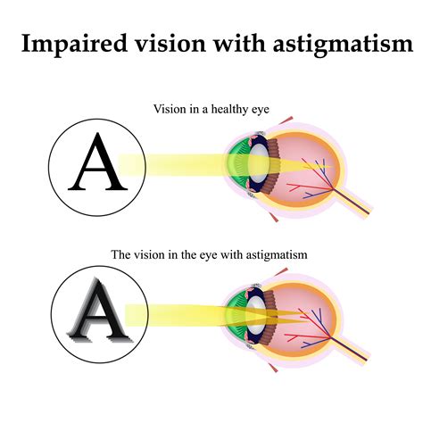 I’ve Got Astigmatism, Can I Get LASIK? | VisionFirst Eye Center