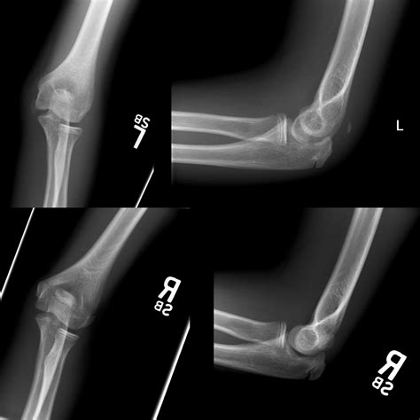 School ager with left medial epicondyle pain after a fall | Pediatric ...