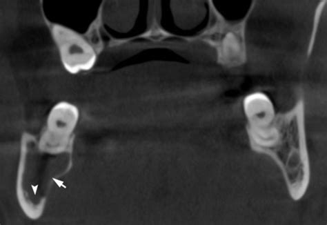 Simple Bone Cyst Mandible