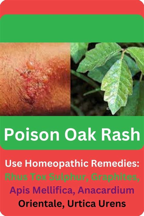 Homeopathic Remedies for Poison Oak Rash | Homeopathic remedies, Poison oak rash, Homeopathic