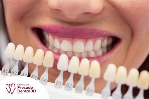 Qu Son Las Carillas De Composite Centro De Fresado Dental D