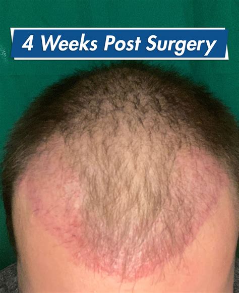 Redness After Hair Transplant How To Reduce And How Long It Lasts