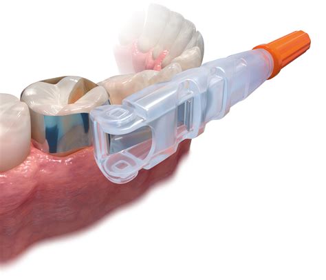 ultradent introduces omni matrix disposable retainer  matrix