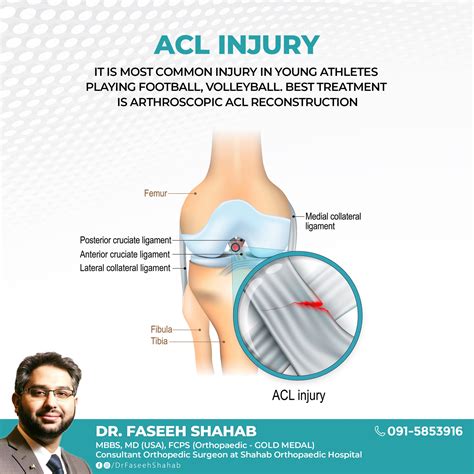 Dr Faseeh Shahab - An ACL injury is a tear or sprain of the anterior