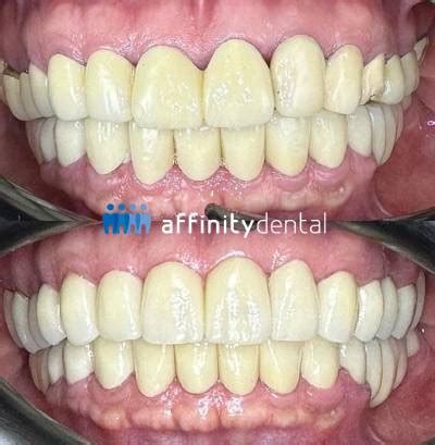 zirconia  pfm crowns