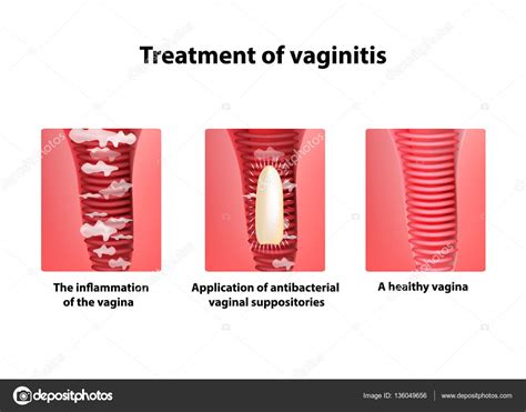 Treatment Of Vaginitis Suppositories Inflammation The Vagina