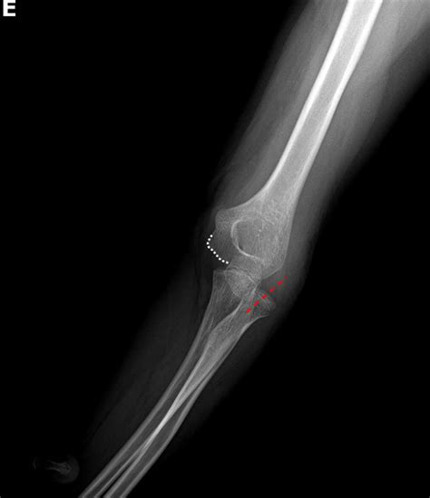 Radial Head Dislocation With Ulnar Bowing Image Radiopaedia Org