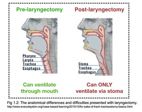 When A B And C Collide Tracheoinnominate Fistula Management