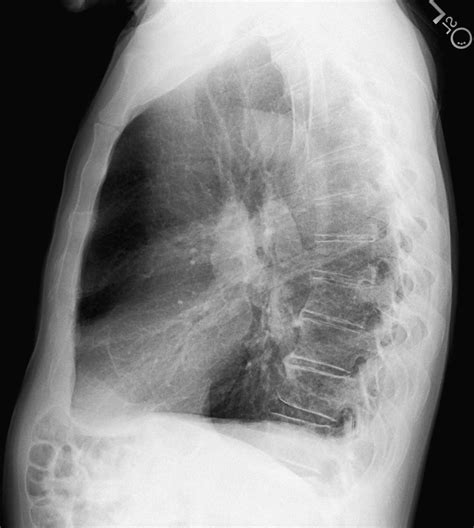 Lateral Chest Radiograph Academic Radiology