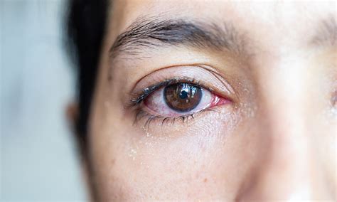tear duct surgery aspect eye surgeons