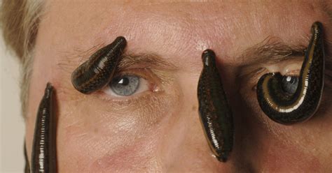 leeches  bizarrely good  human health  incredible benefits