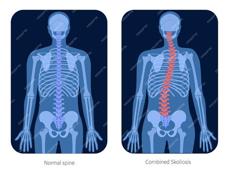 Premium Vector | Combined scoliosis on x ray vector illustration. spine