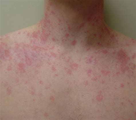 Pictures Of Pityriasis Rosea Pictures Photos