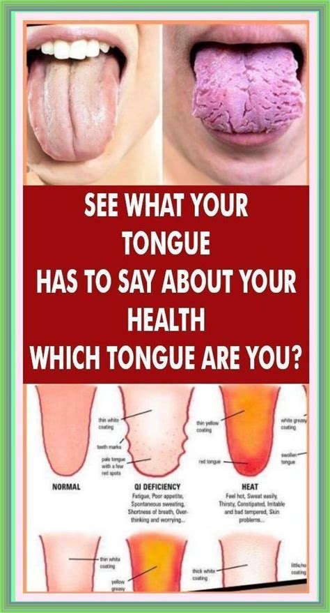How To Heal A Sore Tongue 13 Steps With Pictures Artofit