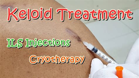 Keloid Scars Treatment Ils Intralesional Steroid Injections