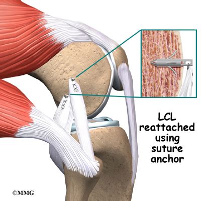 Collateral Ligament Injuries - eOrthopod.com