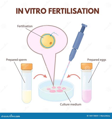 Stages Of In Vitro Fertilization Medical Banner Vector Illustration ...