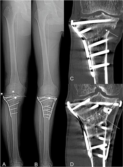 Re Correction HTO Case 1 In Table 1 A Full Length Anteroposterior