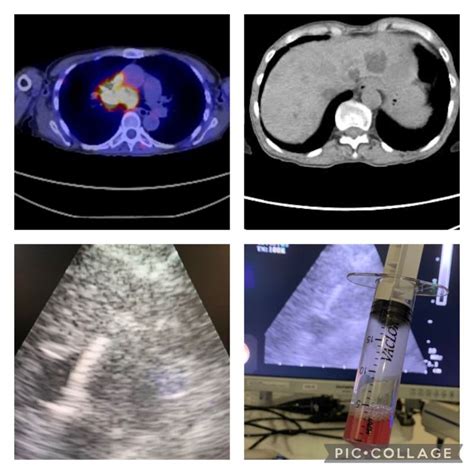 Roshen Mathew Md Daabip On Linkedin Esophageal Ultrasound Eus An
