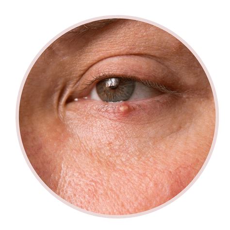 White Bump On Eyelid Causes Treatment Remedies Pictures Molluscum