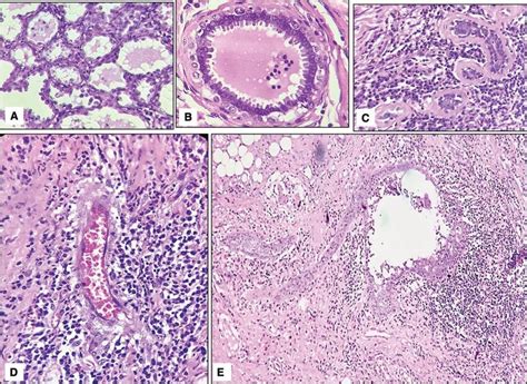 Various Histological Appearances Of Granulomas A Lobular Well Download Scientific Diagram