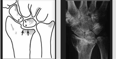 Wrist Hand Pathologies Flashcards Quizlet