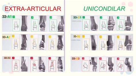 Fractura De Femur Distal Carmennnpptx