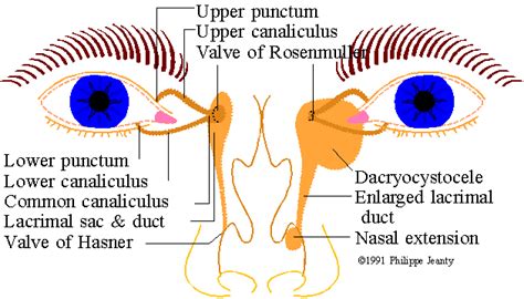 dacryocystocele