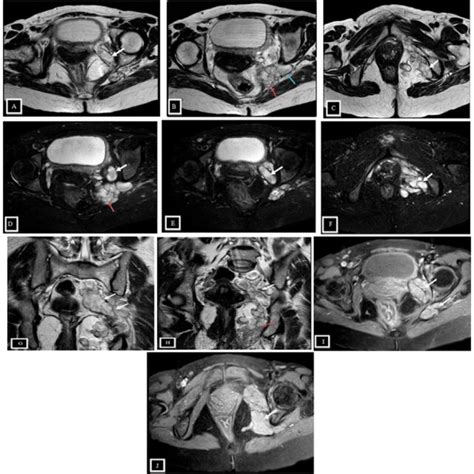 Lumbosacral Plexus Magnetic Resonance Neurography Imaging Protocol [1