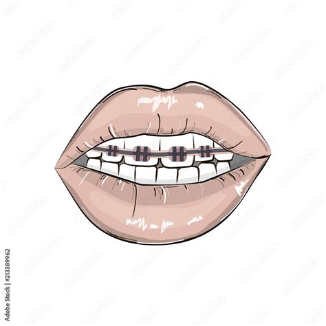 Grafika Wektorowa Stock Sexy Red Lips Braces Illustration Erotic Playful Hot Clipart Modern